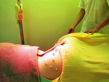 アフターバースケア鍼灸の画像